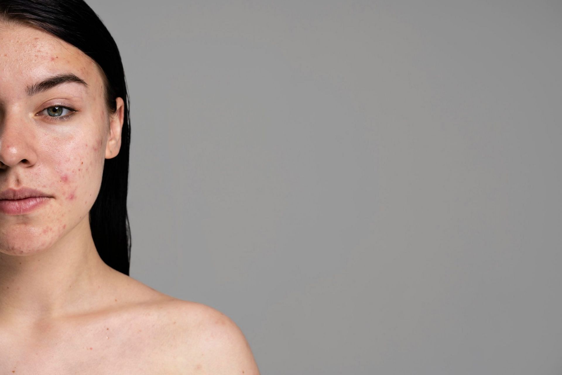 Ayurvedic Remedies for Acne (Image via Freepik)